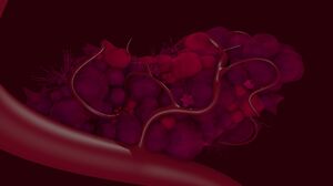 Picture showing a tumor 
