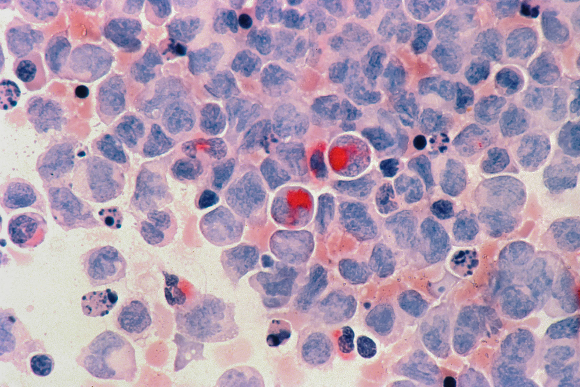 Acute myelocytic leukaemia (AML). Photo.