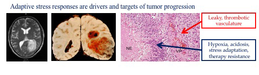 Adaptive stress responses drives tumor progression; brain tumour illustration.